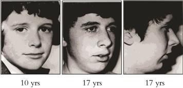 two classic cases of orthodontics on how mouth breathing can adversely affect one’s facial development