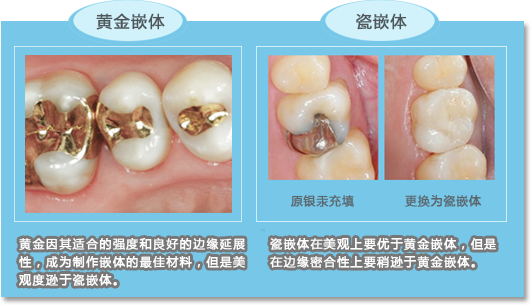 瓷嵌体在美观上要优于黄金嵌体，但是在边缘密合性上要稍逊于黄金嵌体