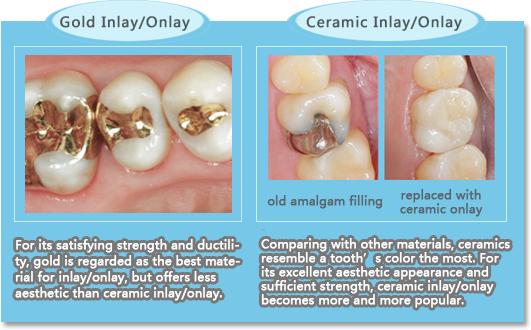 ceramic inlay looks prettier than golden inlay but worse at margin.