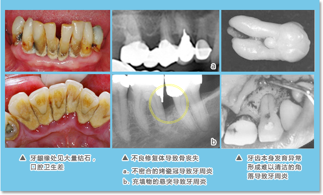 被称为细菌温床的菌斑和结石是引发牙周疾病的最主要的因素